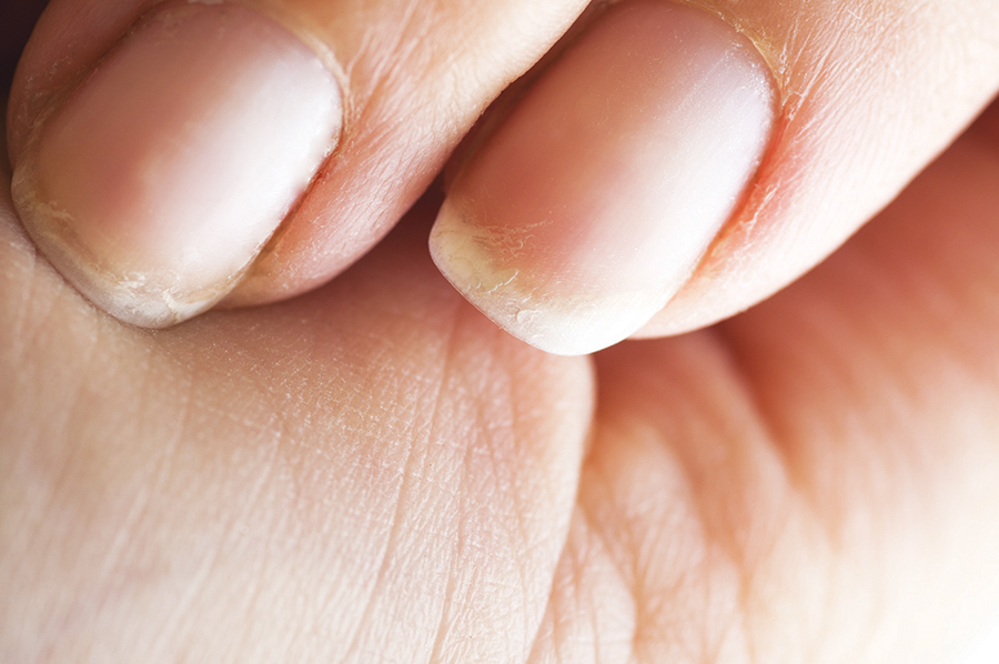 What Causes Toe Nails To Peel Off